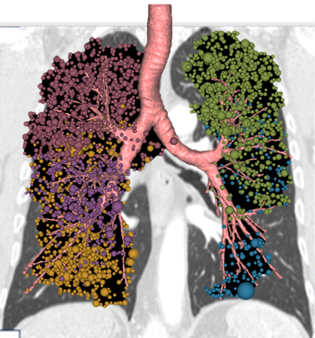 lung cancer risk image