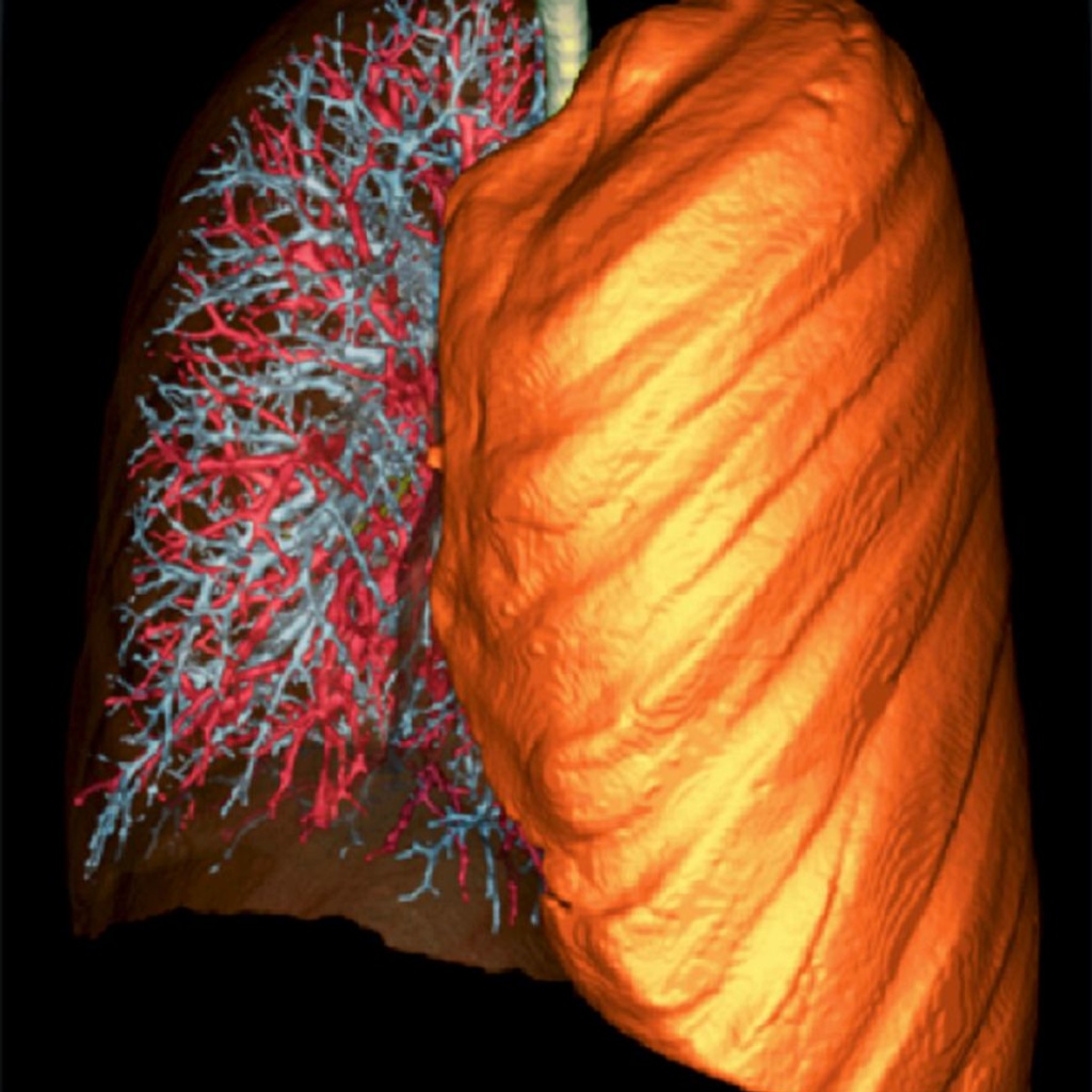 3D Image of a Lung