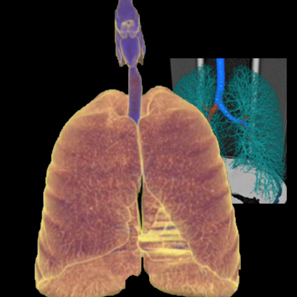 3D Image of a Lung