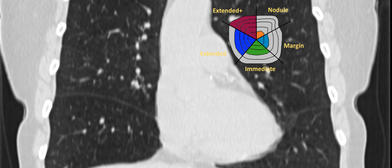 X-Ray of a Lung