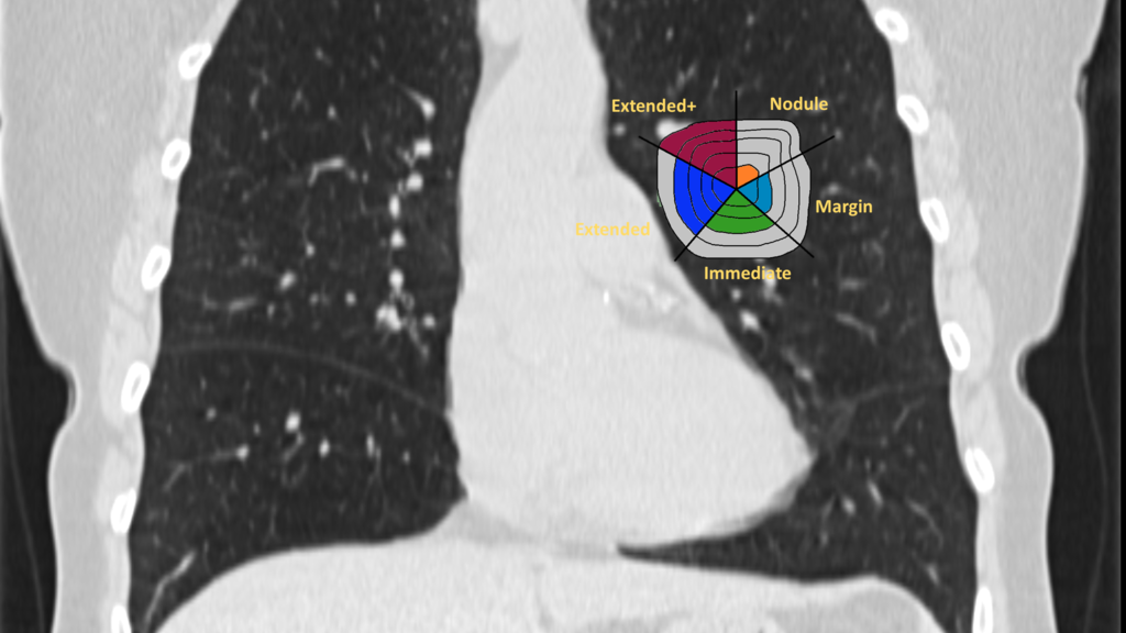 X-Ray of a Lung