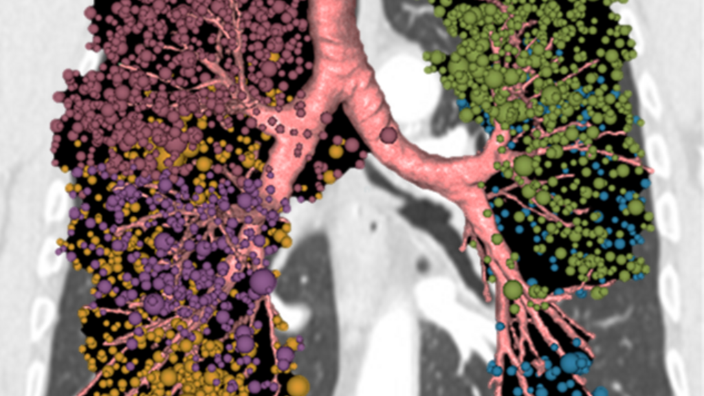 lung cancer risk image